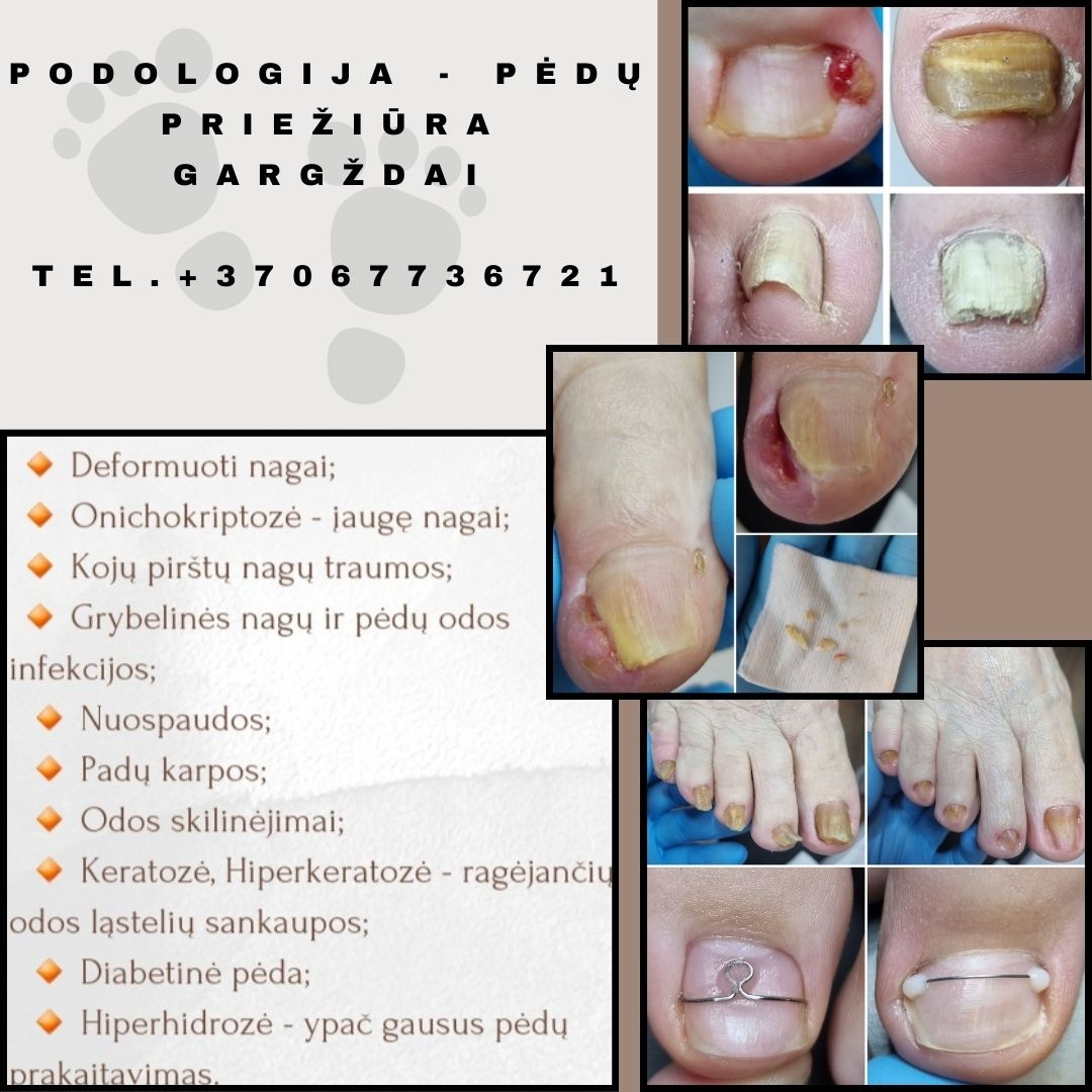 Podologija – Pėdų priežiūra Gargždai